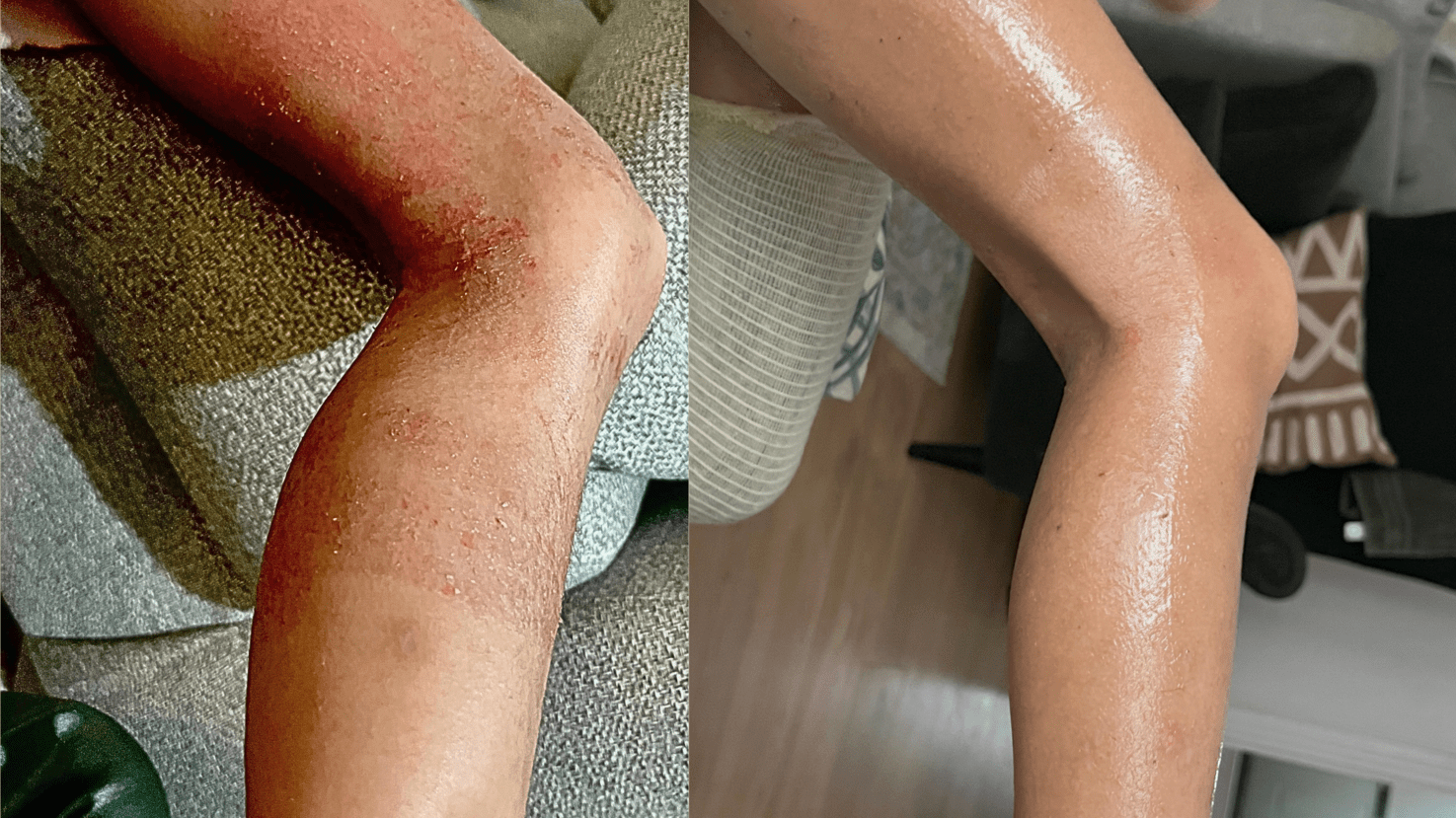 مرهم تامو العضوي لإنقاذ الأكزيما