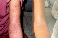 Comparison of skin conditions on two arms, one with visible lesions and the other appearing healthier.