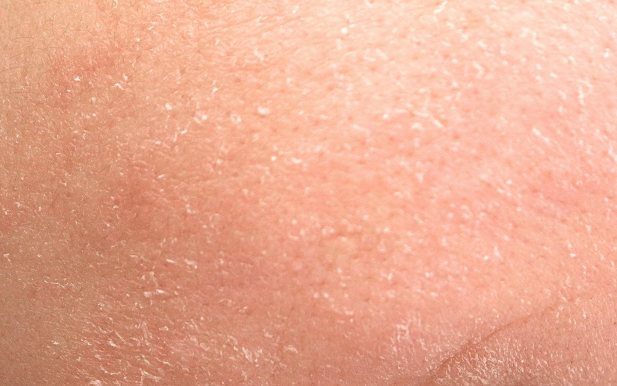 Sensitive Skin
