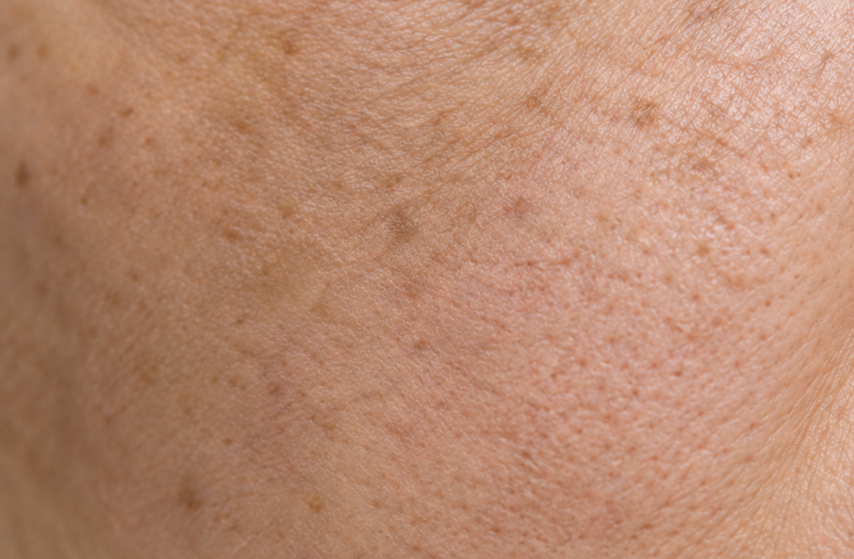 Dull &amp; Tired skin
