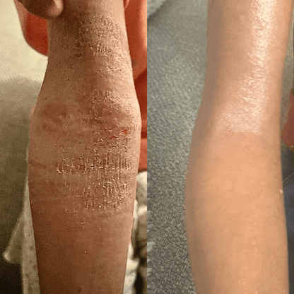 Eczema rescue