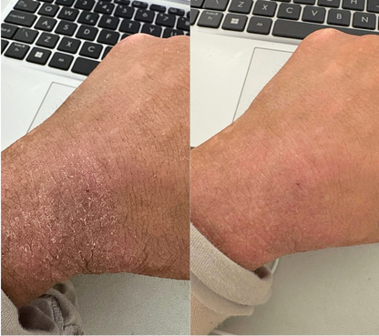 Eczema skin comfort duo