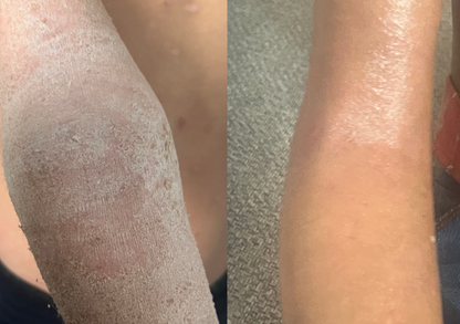 Eczema rescue